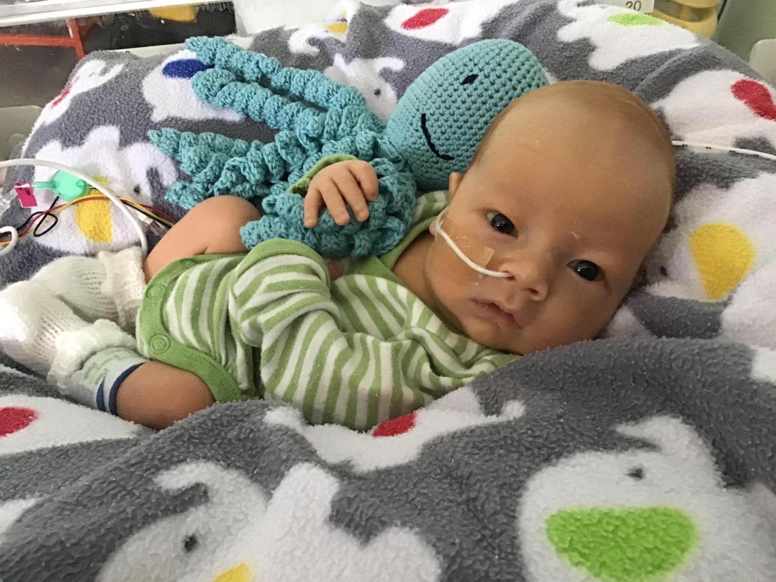 Jothi as a small baby with an NG tube in his nose.