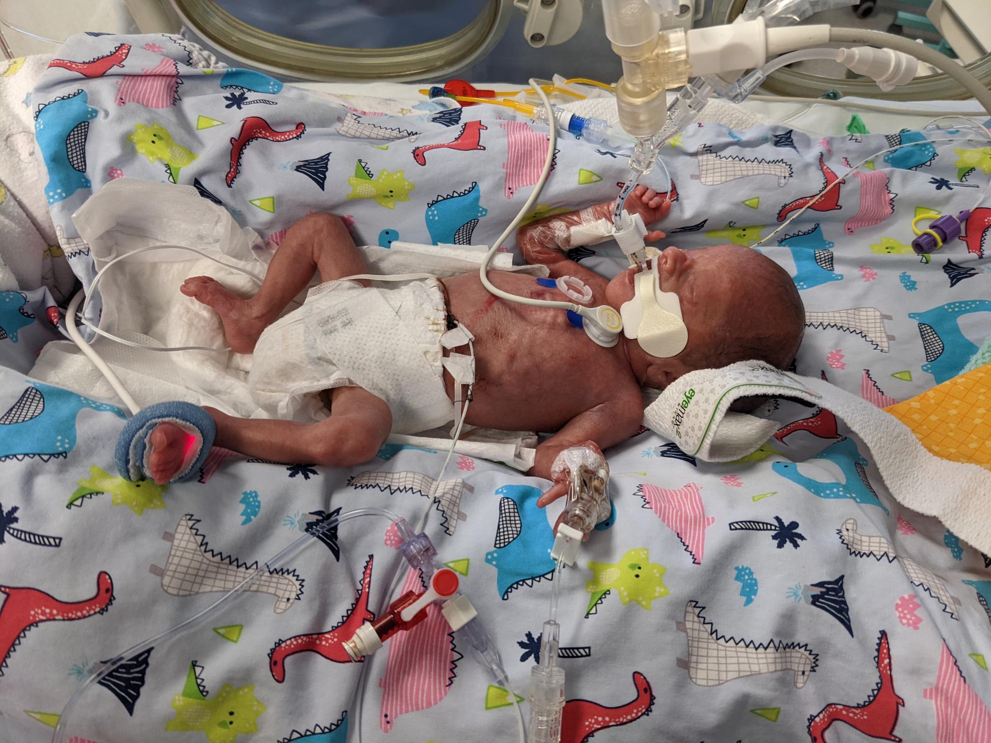 Otis as a baby in the NICU hooked up to a ventilator.