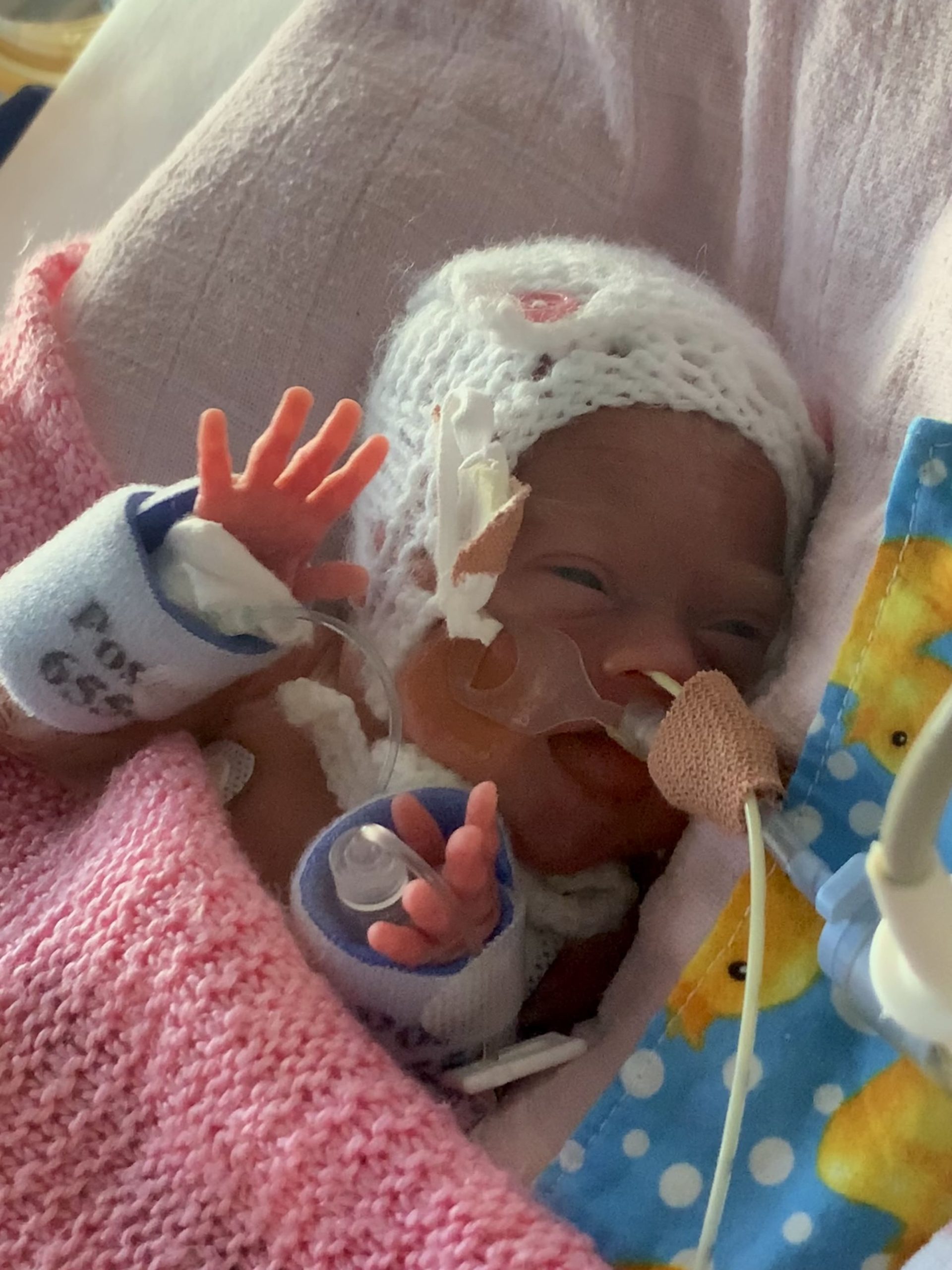 Elsie as a premature baby with an NG tube in her nose.