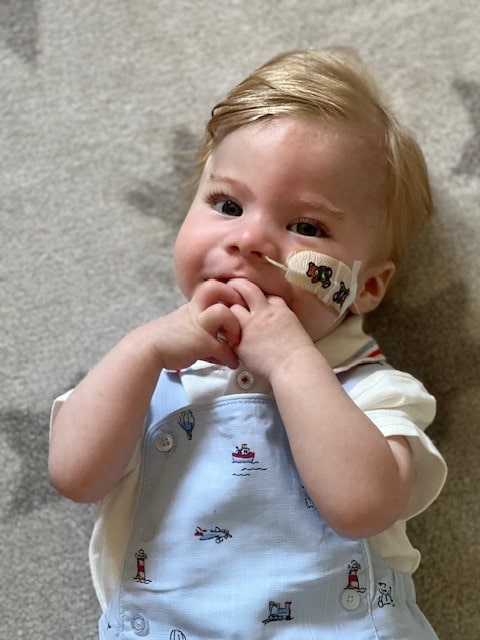 A young boy with an NG tube in his nose, looking at the camera.